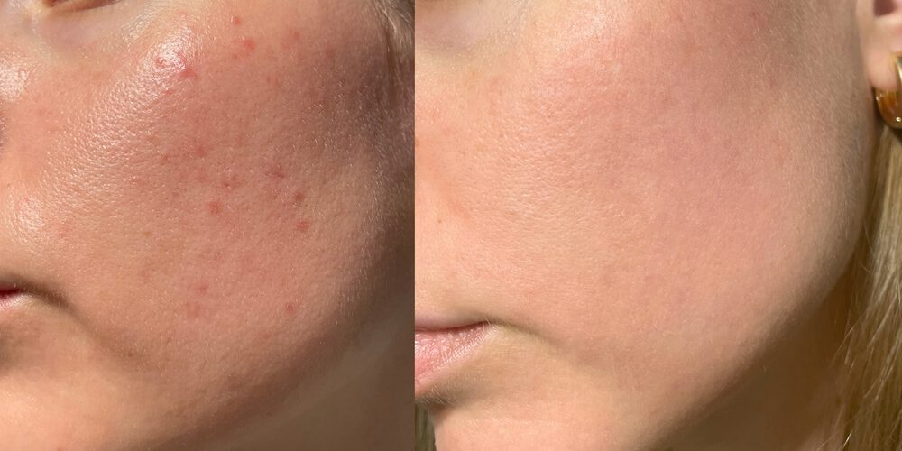 redness women skin redness