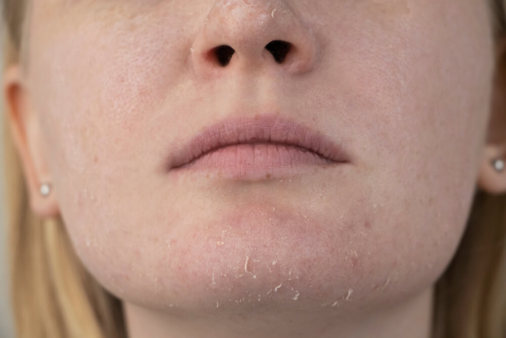 woman dry skin