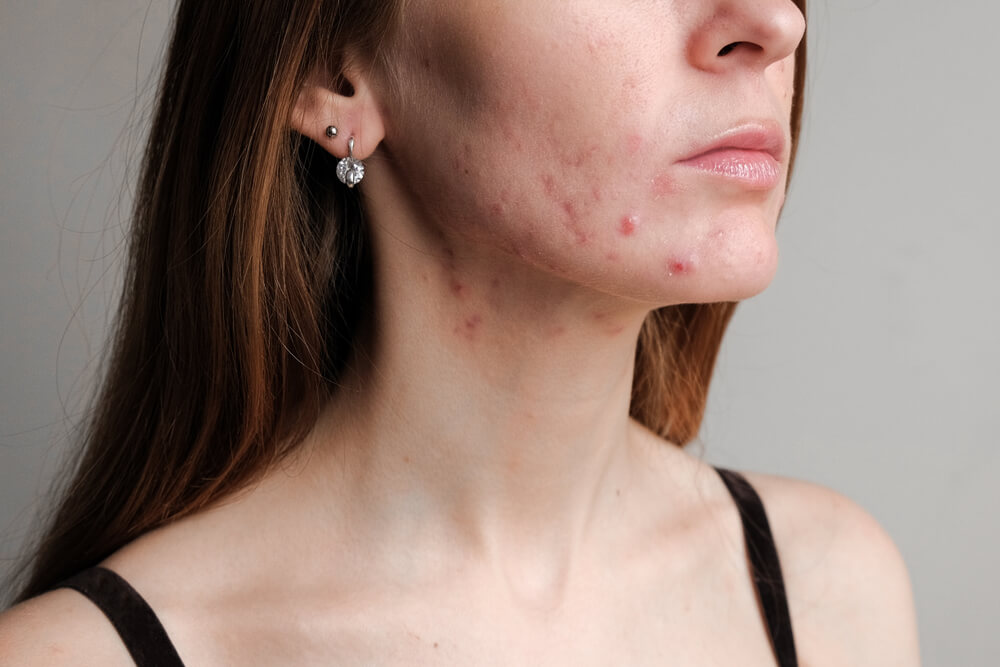 woman hormonal acne