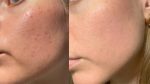 women skin redness